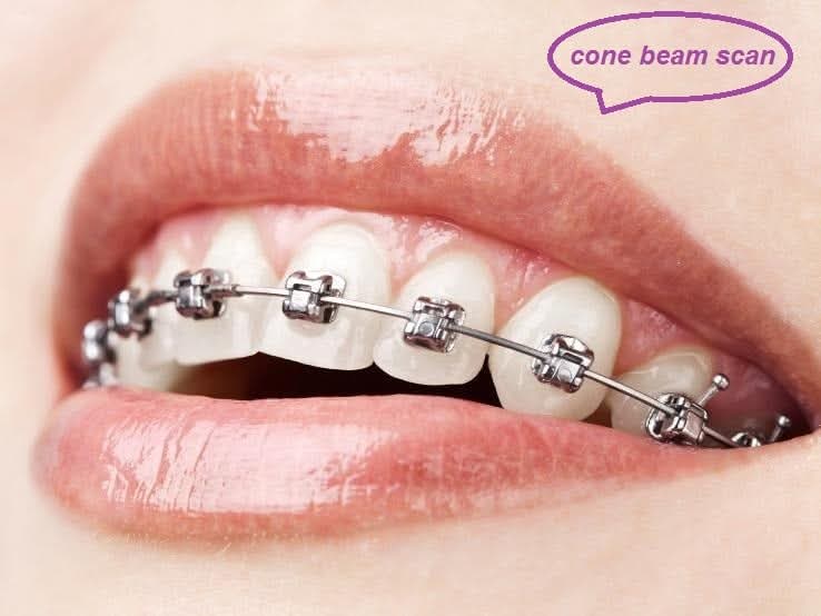 ليه أشعة Lateral Cephalometry خطوة أساسية قبل التقويم؟
