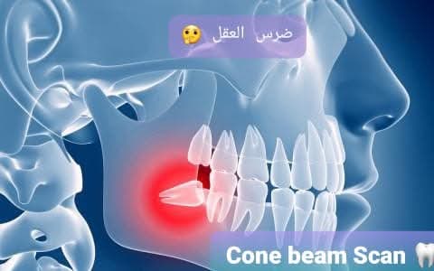 ليه أشعة الـ CBCT خطوة أساسية قبل قرار خلع ضرس العقل؟
