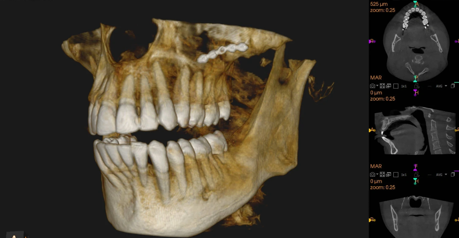 اشعة مقطعيه علي الاسنان cbct