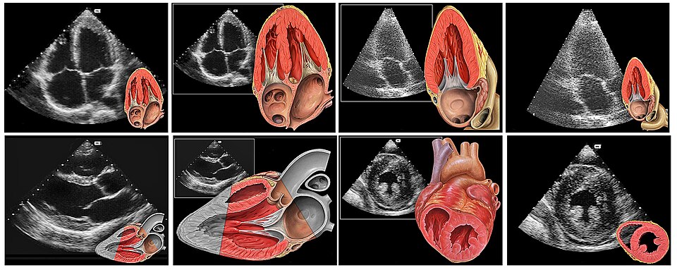الإيكو علي القلب Echocardiogram