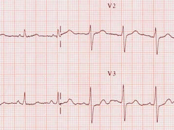 رسم القلب ECG