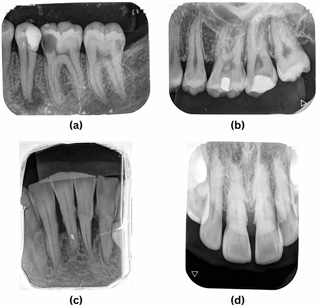 الأشعة العاديه للأسنان Dental X-Ray