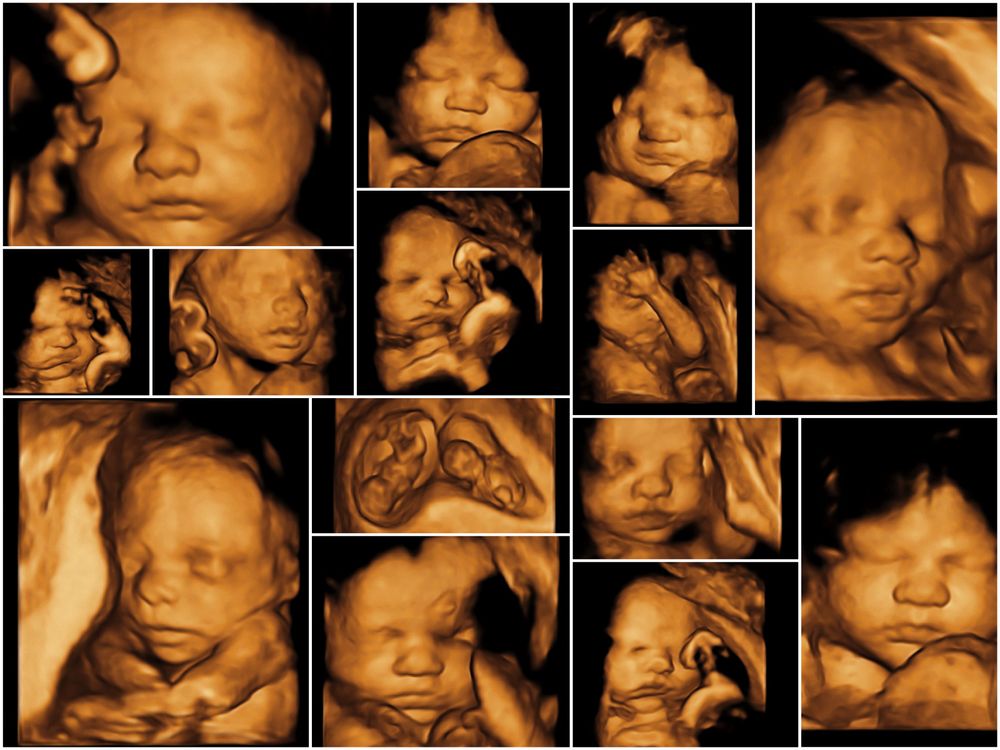سونار الحمل رباعي الأبعاد 4D Ultrasound